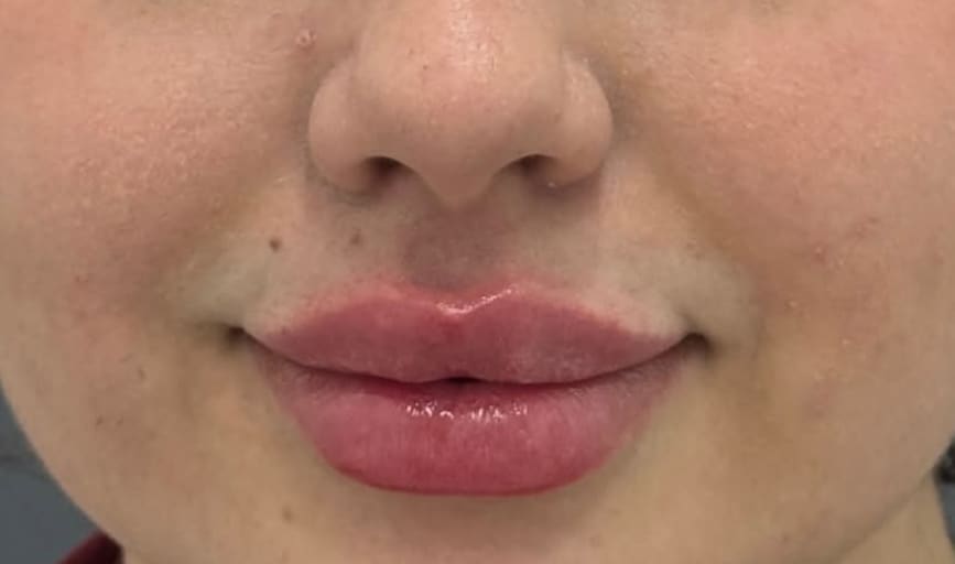 Lip Fillers